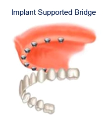 Dental Implants in Sheffield, tooth implant, flint, dental,  cosmetic dentistry Sheffield